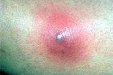 Hà Nội: Một phụ nữ có nguy cơ tử vong vì tự nặn nhọt