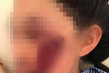 Áo chống nắng cuốn vào bánh xe, nữ sinh ngã chấn thương nghiêm trọng