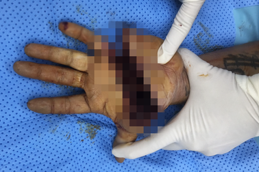 Chàng trai bị chém gần đứt lìa tay được cứu "ngoạn mục"