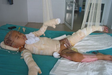 Bé 3 tuổi bỏng vôi toàn thân lên bàn mổ lần thứ 6