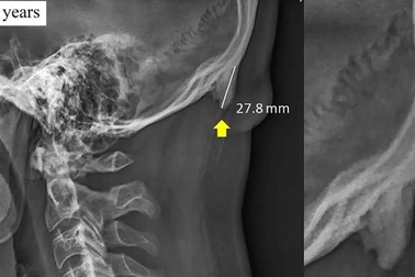“Mọc sừng” do dán mắt vào điện thoại có nguy hiểm không?