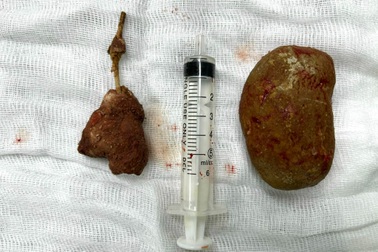 Sỏi to như quả trứng gà trong  bàng quang người đàn ông 27 tuổi