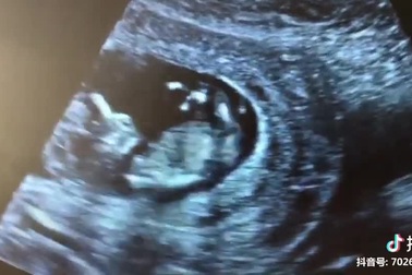 Bật cười với hình ảnh em bé "đánh đu" trong bụng mẹ