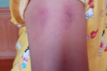 Chủ tịch huyện chỉ đạo xử lý nghiêm giáo viên đánh bé gái lớp 1 bầm tím