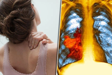 Đau vai có đặc điểm này cần cảnh giác với ung thư phổi