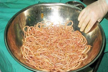 Lấy hơn 300 con giun từ bụng bệnh nhi