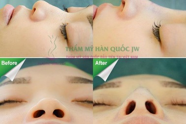 Nâng mũi s line có nhất thiết phải gây mê hay không?