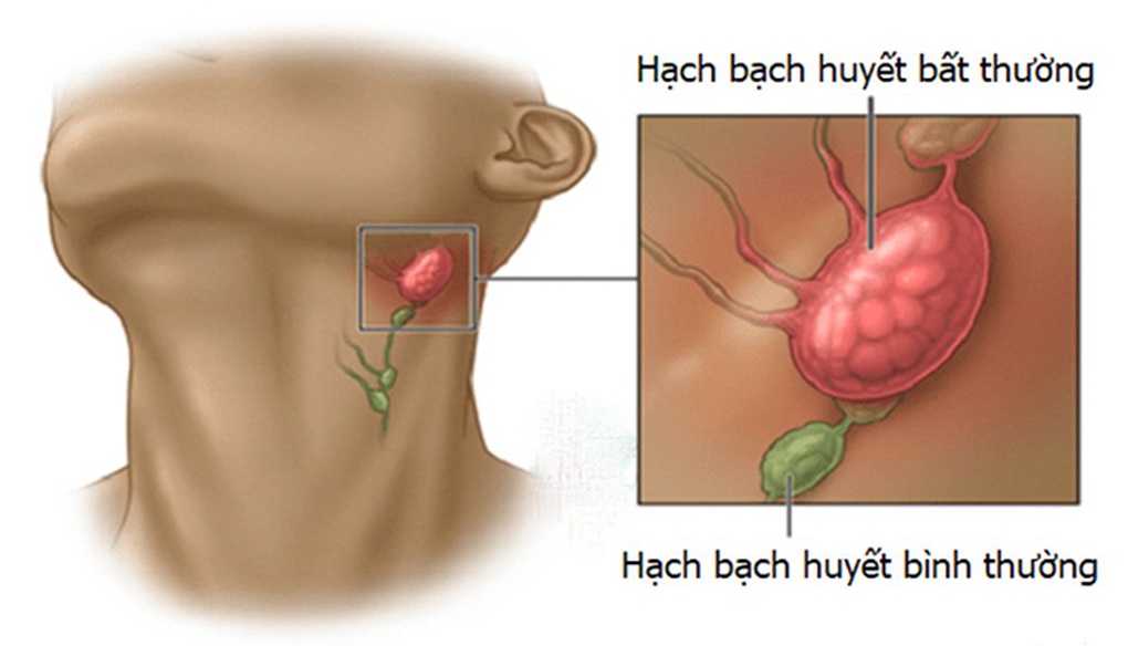 Nguyên nhân gây sưng hạch ở trẻ em - 1 Nguyên nhân gây sưng hạch ở trẻ em - 1