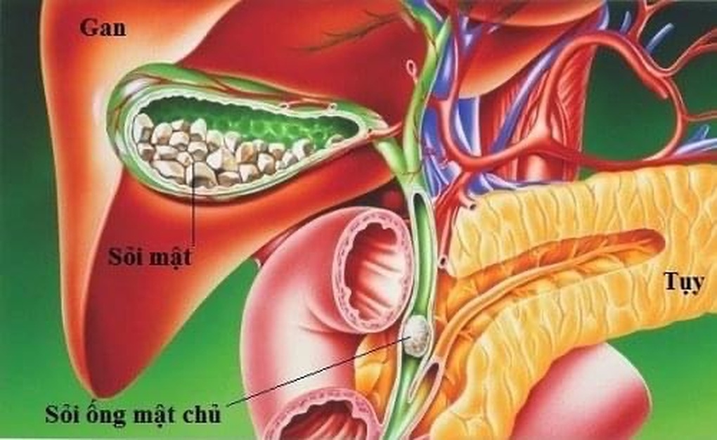 5 triệu chứng cảnh báo sỏi túi mật bạn cần biết - 1