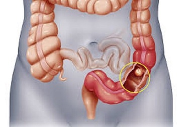 Polyp đại tràng nào có nguy cơ tiến triển thành ung thư?