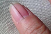 Những dấu hiệu bất thường trên bàn tay "chỉ điểm" ung thư giai đoạn đầu