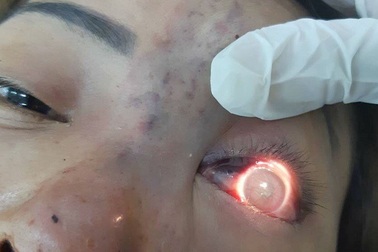 Phạt 120 triệu đồng cơ sở spa tiêm filler khiến bệnh nhân mù mắt