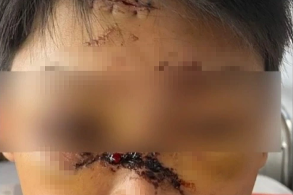 Kẹt chân vào bánh xe, chó cắn nát mặt và những hiểm họa tấn công trẻ mùa hè - 3 Kẹt chân vào bánh xe, chó cắn nát mặt và những hiểm họa tấn công trẻ mùa hè - 3