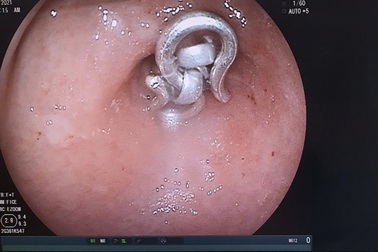 Bé trai 8 tháng tuổi nuốt sợi dây chuyền bạc 15cm vào bụng