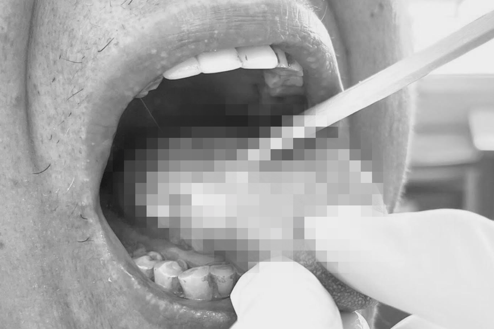 Tự mua thuốc trị đau họng, người đàn ông phải cắt lưỡi vì căn bệnh quái ác - 1 Tự mua thuốc trị đau họng, người đàn ông phải cắt lưỡi vì căn bệnh quái ác - 1