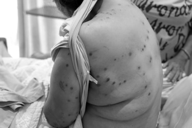 Người phụ nữ bị 70 con ong vò vẽ đốt nguy kịch khi tập thể dục gần nhà