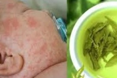 Trị rôm sảy cho trẻ bằng trà xanh rất công hiệu
