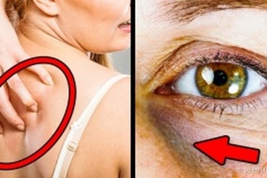 12 dấu hiệu cho thấy đường máu tăng cao