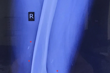 Sán chi chít trong người vì món cá đặc sản