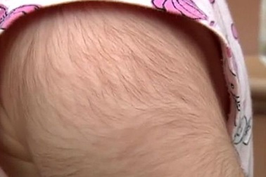 Uống nhầm thuốc mọc tóc thay siro đau bụng, mắc hội chứng "người sói"