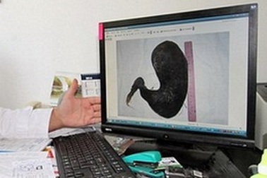 Choáng với búi tóc nặng 4 kg bị mắc kẹt trong dạ dày thiếu nữ