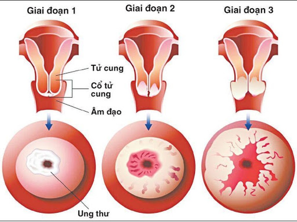 4. Các phương pháp điều trị ung thư cổ tử cung