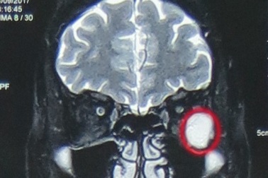 Bỗng dưng nhìn mờ, chảy nước mắt do u hốc mắt nguy hiểm