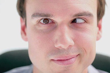 Bệnh mắt lác - Nguyên nhân, tác hại, cách chữa trị