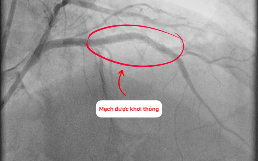 Can thiệp thành công cho bệnh nhân tái hẹp nặng mạch vành sau 15 năm đặt stent - 3