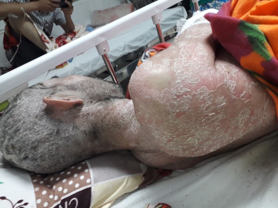 Nỗi khổ đau chồng chất của người đàn ông không dám cựa mình vì da nứt toác - 2 Nỗi khổ đau chồng chất của người đàn ông không dám cựa mình vì da nứt toác - 2