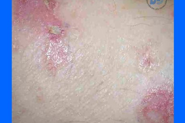 Dày sừng ánh sáng - cẩn thận ung thư da