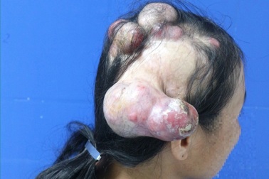 Người phụ nữ "mọc sừng" kỳ lạ một nửa đầu, to đến 20cm