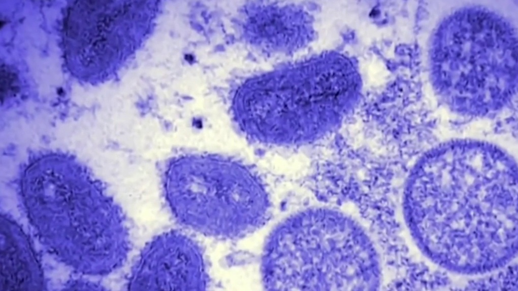 Virus đậu mùa khỉ có thể bám lâu trên các bề mặt trong nhà - 1 Virus đậu mùa khỉ có thể bám lâu trên các bề mặt trong nhà - 1