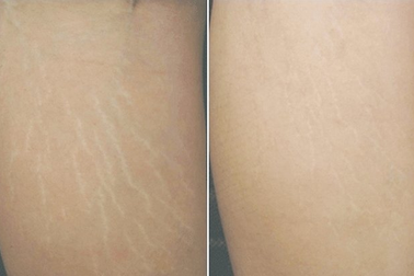 Cách cải thiện rạn da sau sinh lâu năm hiệu quả nhất năm 2019