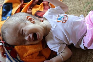 Đầu sắp nổ tung, bé trai bị não úng thủy chưa một lần được đi bệnh viện