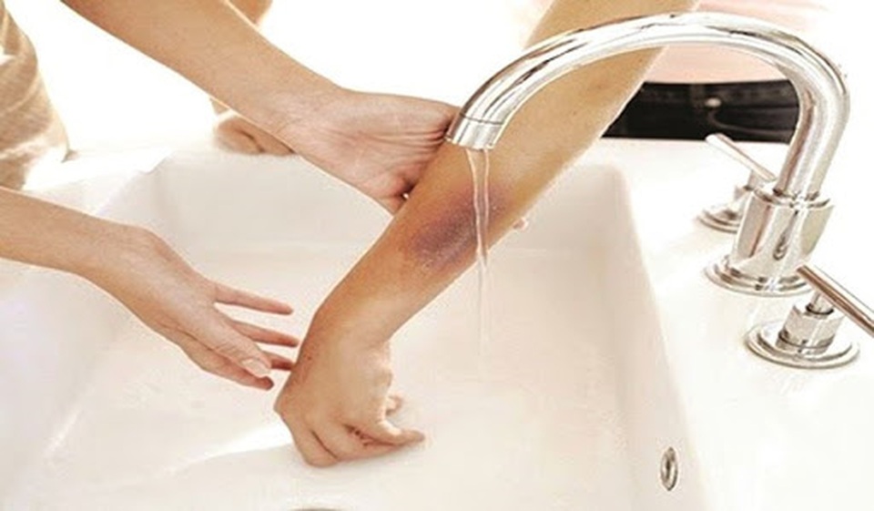 Mẹ dùng kem đánh răng chữa bỏng, bé trai phải nằm viện 4 tuần - 3 Mẹ dùng kem đánh răng chữa bỏng, bé trai phải nằm viện 4 tuần - 3