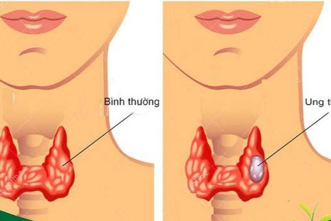 Những điều cần biết về chọc tế bào tuyến giáp bằng kim nhỏ - 1 Những điều cần biết về chọc tế bào tuyến giáp bằng kim nhỏ - 1