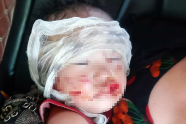 Bé trai 3 tuổi bị chó dữ tấn công