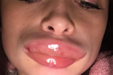 Tiêm chất làm đầy tại nhà, nữ y tá gặp họa bong tróc và sưng vều môi