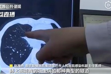 Khó thở kéo dài, phát hiện sán đầy trong phổi