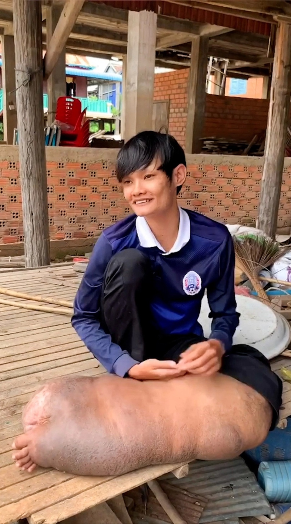 Bị muỗi đốt không điều trị, người đàn ông mang “bàn chân lợn” suốt 21 năm - 2 Bị muỗi đốt không điều trị, người đàn ông mang “bàn chân lợn” suốt 21 năm - 2