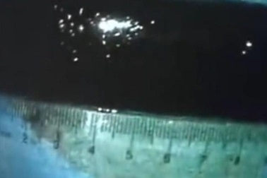 20 năm sống với cái bật lửa… trong bụng