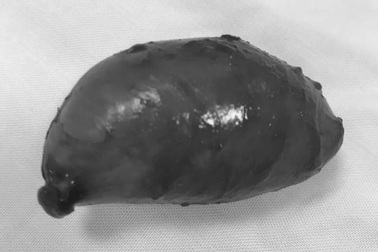 Phẫu thuật thành công khối u lớn hiếm gặp ở vùng cổ