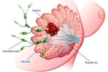 Ung thư có thể gây ảnh hưởng đến tim