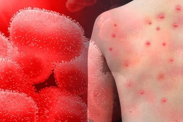 Các dấu hiệu nguy hiểm của bệnh đậu mùa khỉ