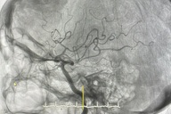Cục máu đông khiến cụ bà suýt mất hàng triệu tế bào não mỗi phút