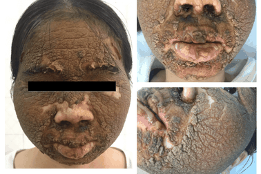 Hà Nội: Hoảng hồn nhìn cô gái mặt đen xì, sần như vỏ cam vì bôi thuốc làm trắng da