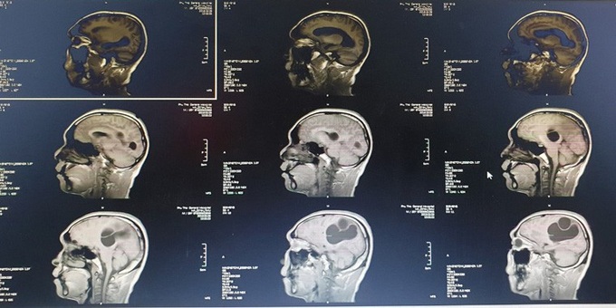 Kinh hoàng một bệnh nhân mắc tổ sán khổng lồ trong não do thói quen ăn những món này - Ảnh 1. Kinh hoàng một bệnh nhân mắc tổ sán khổng lồ trong não do thói quen ăn những món này - Ảnh 1.