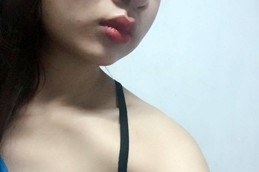 Mặt sưng phù vì làm má lúm đồng tiền tại nhà