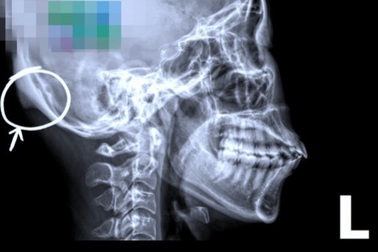 Người phụ nữ ở TPHCM mắc bệnh "mọc đuôi" ở sọ vì cầm smartphone sai cách